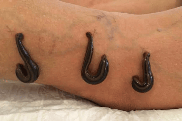 Rakta Moshan therapy at D.G. PanchaKarma